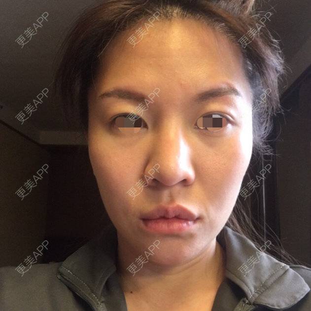 更美 - 更美用户3ZvSZOXJUd的自体脂肪丰面颊经验 | 自体脂肪丰额头太阳穴面颊 | 北京 | 自体脂肪丰面颊