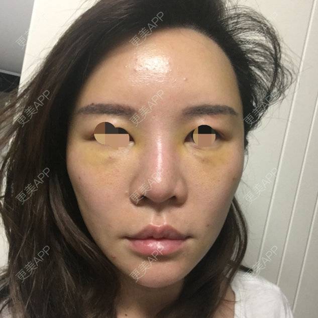 更美 - 更美用户3ZvSZOXJUd的自体脂肪丰面颊经验 | 自体脂肪丰额头太阳穴面颊 | 北京 | 自体脂肪丰面颊