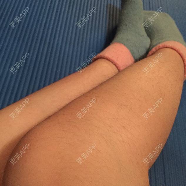 更美 - 奔奔～的面部脱毛经验 | 美购日记 | 瘦脸除皱 | 面部脱毛 | 上海