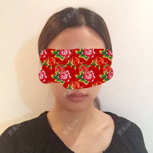 更美 - OMGGGGGG的经验 | 术后求抱抱 | 面部轮廓 | 北京 | medpore 垫下巴
