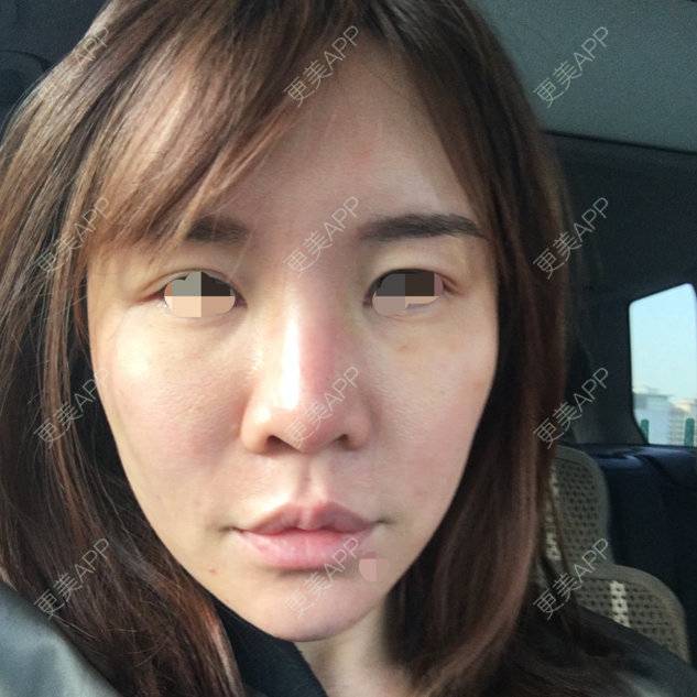 更美 - 更美用户3ZvSZOXJUd的自体脂肪丰面颊经验 | 自体脂肪丰额头太阳穴面颊 | 自体脂肪丰苹果肌 | 北京 | 自体脂肪丰面颊