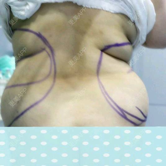 更美 - 更美用户uZORQp6lKw的腰腹吸脂经验 | 晒对比照 | 宜昌 | 水桶腰 | 吸脂 | 腰腹吸脂