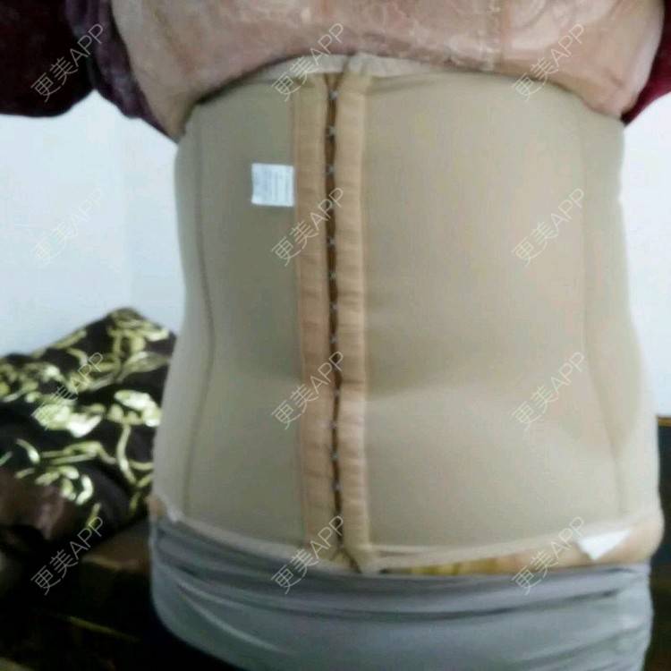 更美 - 更美用户uZORQp6lKw的腰腹吸脂经验 | 晒对比照 | 宜昌 | 水桶腰 | 吸脂 | 腰腹吸脂