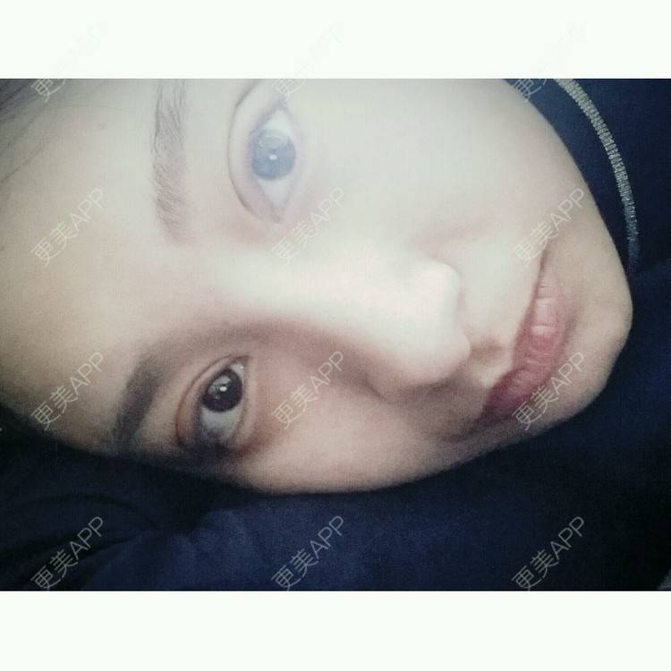 更美 - Sylviace的双眼皮经验 | 美购日记 | 韩式双眼皮术 | 双眼皮 | 武汉