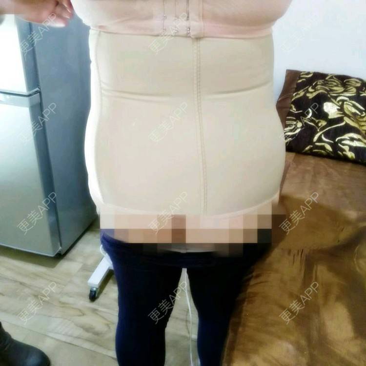更美 - 更美用户uZORQp6lKw的腰腹吸脂经验 | 晒对比照 | 宜昌 | 水桶腰 | 吸脂 | 腰腹吸脂