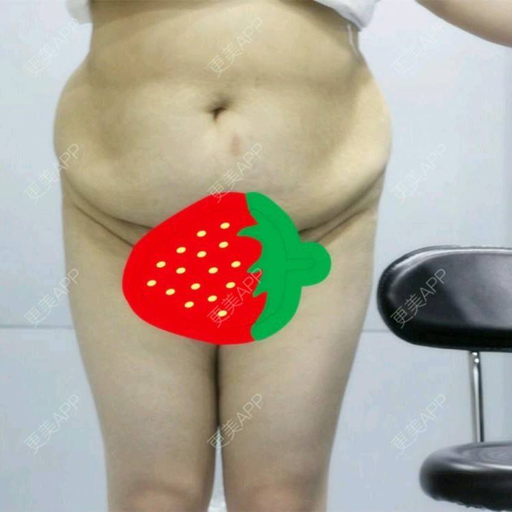 更美 - 更美用户uZORQp6lKw的腰腹吸脂经验 | 晒对比照 | 宜昌 | 水桶腰 | 吸脂 | 腰腹吸脂