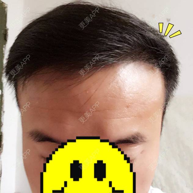 更美 - 曾浩 医生的经验 | 植发其他项目 | 广州