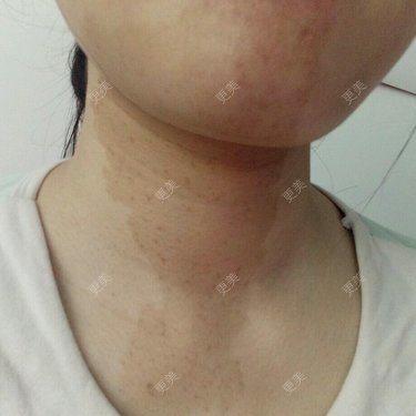 脖子上长了一大块咖啡斑胎记夏天好明显用遮瑕膏什么的根本遮不住好
