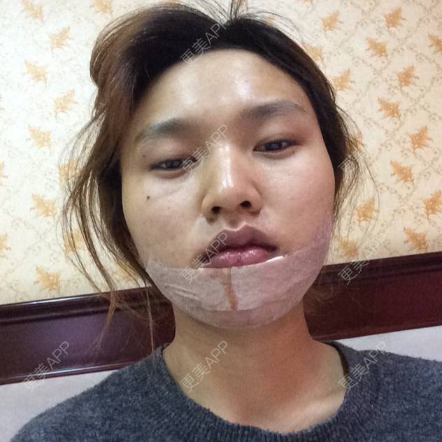 林晨曦sorry的硅胶垫下巴日记