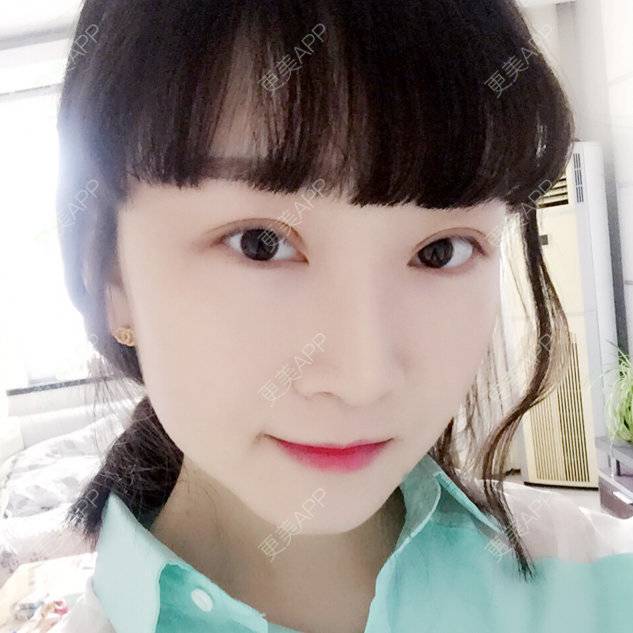 更美 - since biu的全切双眼皮经验 | 唐山 | 全切双眼皮