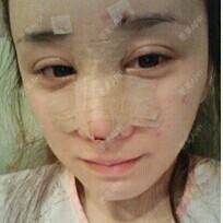 更美 - 美德2016的自体脂肪隆鼻经验 | 广州 | 自体脂肪隆鼻 | 隆鼻