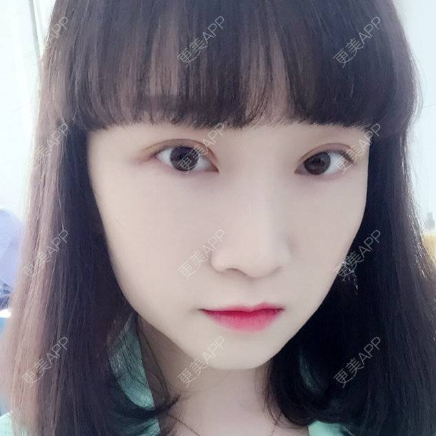 更美 - since biu的全切双眼皮经验 | 唐山 | 全切双眼皮