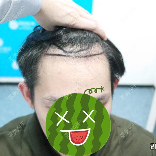 更美 - 曾浩 医生的经验 | 植发其他项目 | 广州