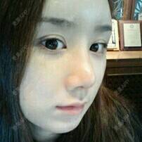 更美 - 美德2016的自体脂肪隆鼻经验 | 广州 | 自体脂肪隆鼻