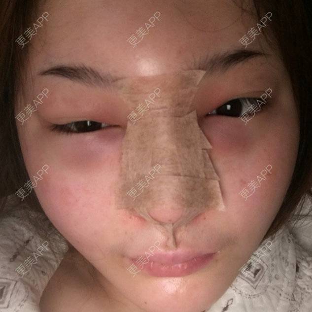 更美 - 等一等再放弃.的经验 | 鼻中隔软骨垫鼻头 | 南通