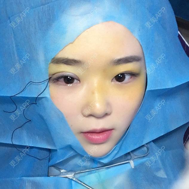 更美 - 丸子酱酱酱的埋线双眼皮日记 | 无痕双眼皮 | 达州 | 埋线双