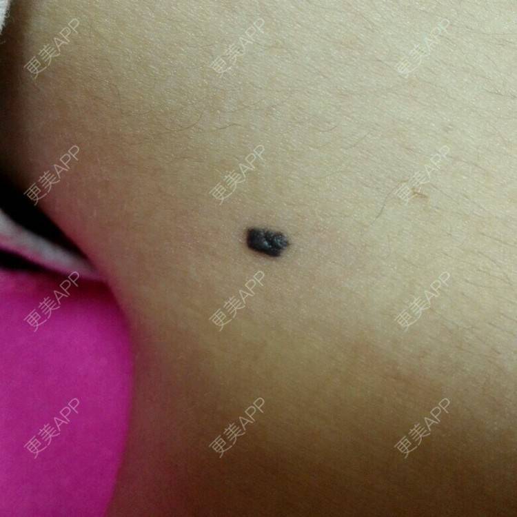 更美 - 更美用户T6TR40zeDy的激光淡疤经验 | 去痣 | 美购日记 | 广州