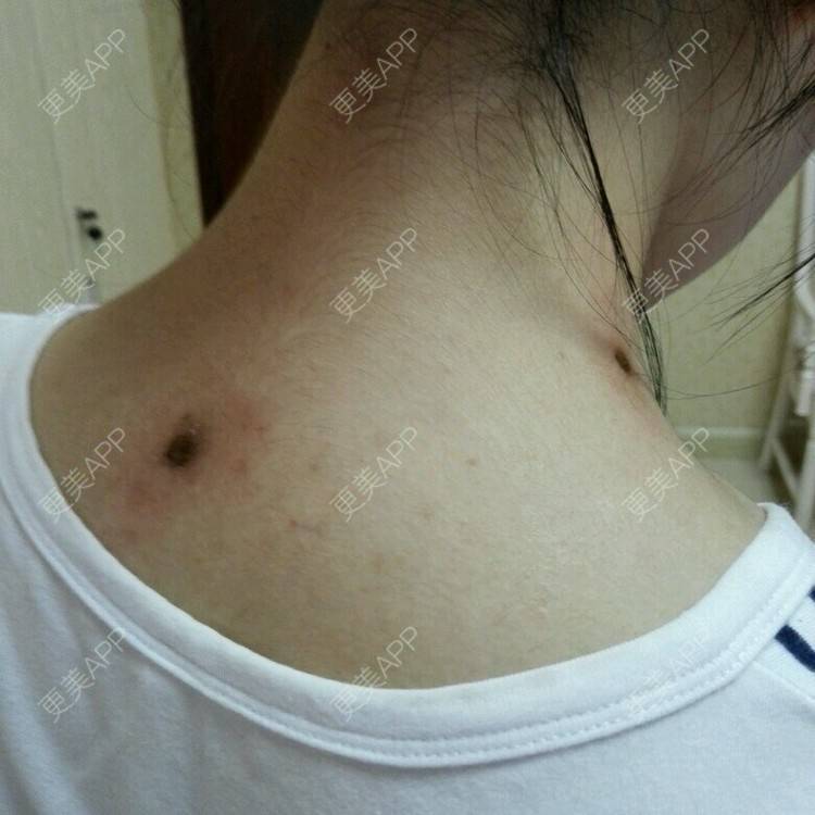 更美 - 更美用户T6TR40zeDy的激光淡疤经验 | 去痣 | 美购日记 | 广州