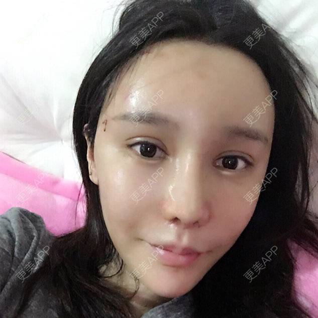 更美 - Jocelyn.T的经验 | 自体脂肪丰面颊 | 自体脂肪丰太阳穴 | 广州