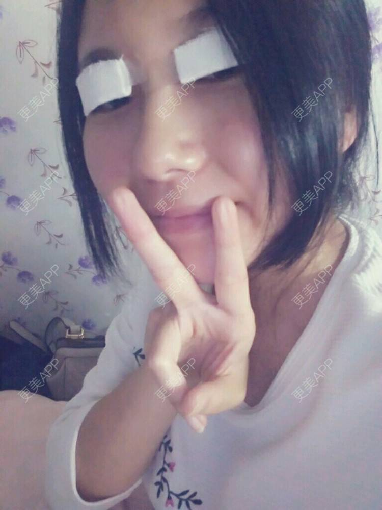 更美 - 筠乔的双眼皮经验 | 美购日记 | 韩式三点加开眼角 | 双眼皮 | 北京
