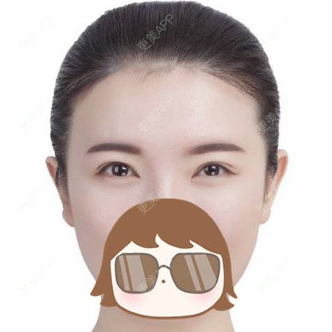 更美 - 焦小宝的眼皮下垂矫正经验 | 上海 | 眼部整形 | 眼皮下垂矫正 | 术后求抱抱