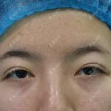 更美 - 焦小宝的眼皮下垂矫正经验 | 上海 | 眼皮下垂矫正