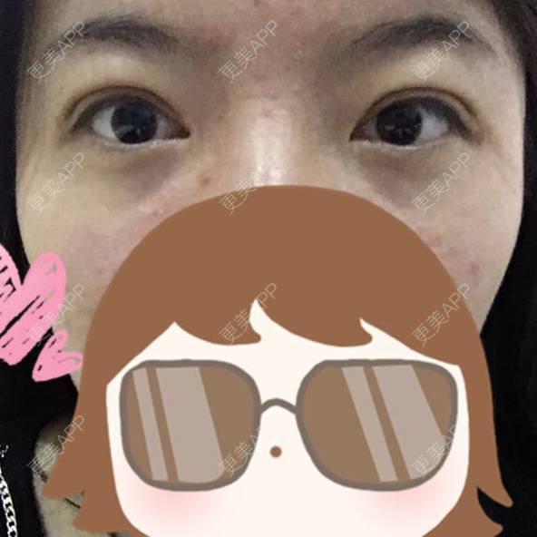 更美 - 焦小宝的眼皮下垂矫正经验 | 上海 | 眼皮下垂矫正