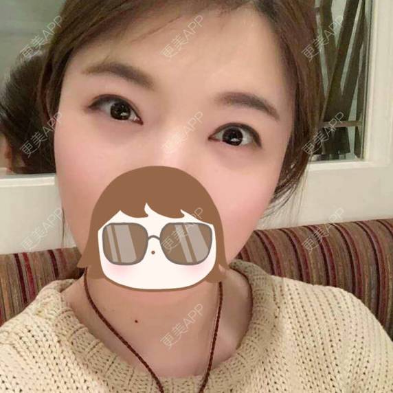 更美 - 焦小宝的眼皮下垂矫正经验 | 上海 | 眼部整形 | 眼皮下垂矫正 | 术后求抱抱