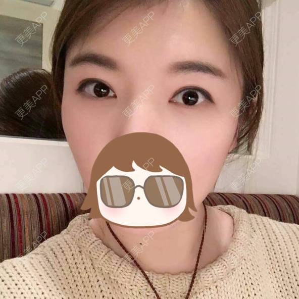 更美 - 焦小宝的眼皮下垂矫正经验 | 上海 | 眼部整形 | 眼皮下垂矫正 | 术后求抱抱