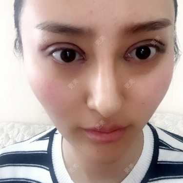 全切双眼皮加开眼角六天了明天打算去拆线消肿了很多一直感觉两边眼角