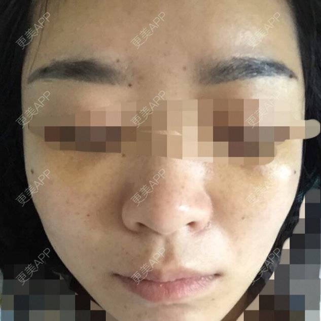 更美 - 更美用户gfNCnJW3D2的经验 | 自体脂肪面部年轻化 | 成都