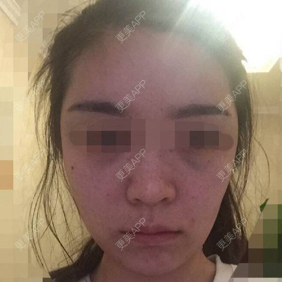 更美 - 更美用户gfNCnJW3D2的经验 | 自体脂肪面部年轻化 | 成都