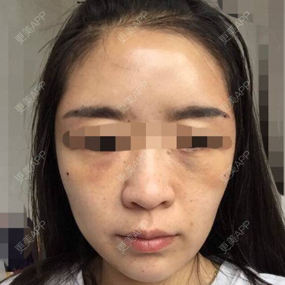 更美 - 更美用户gfNCnJW3D2的经验 | 自体脂肪面部年轻化 | 成都