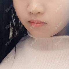 更美 - 更美用户C2FCTNgozG的经验 | 玻尿酸唇部 | 榆林