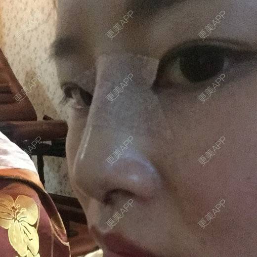 更美 - A～👑Mishine的经验 | 隆鼻 | 怀化 | 热门讨论