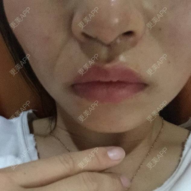 更美 - A～👑Mishine的经验 | 隆鼻 | 怀化