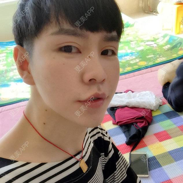 更美 - 陈熙芷的定点双眼皮经验 | 厦门 | 定点双眼皮