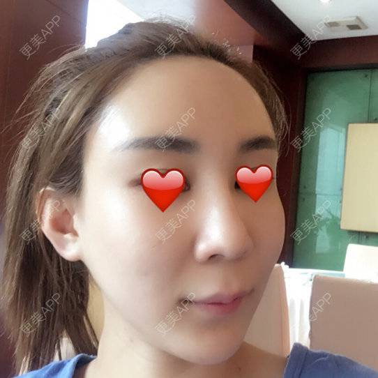 更美 - 阡阡么么哒的经验 | 自体脂肪 | 美购日记 | 丰脸颊 | 胡守舵 | 北京