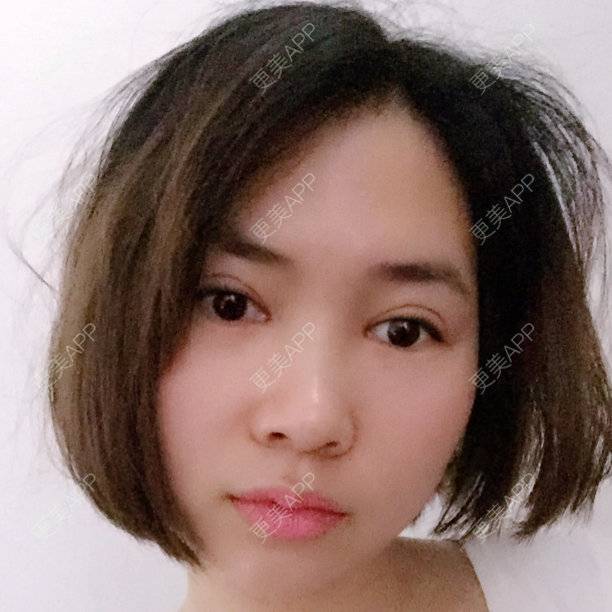 更美 - lolita@的经验 | 美购日记 | 切开内眼角 | 长沙