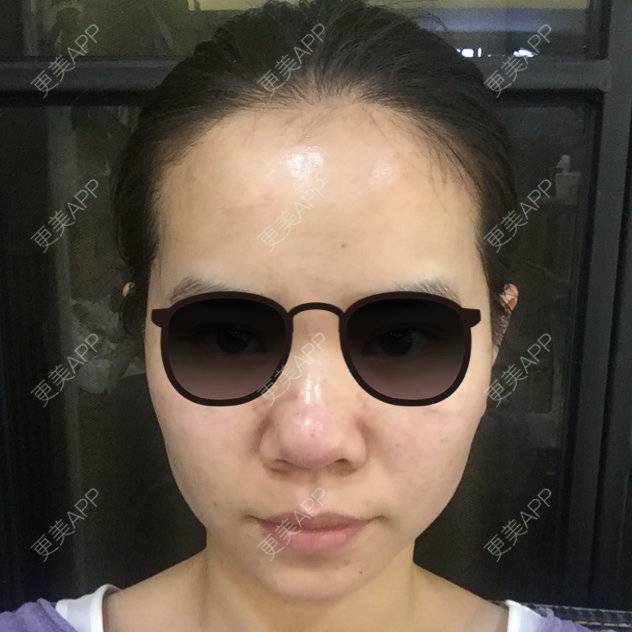 更美 - 123木头人木头人的水光项目经验 | 肉毒杆菌 | 美购日记 | 水光项目 | 缩毛孔 | 武汉