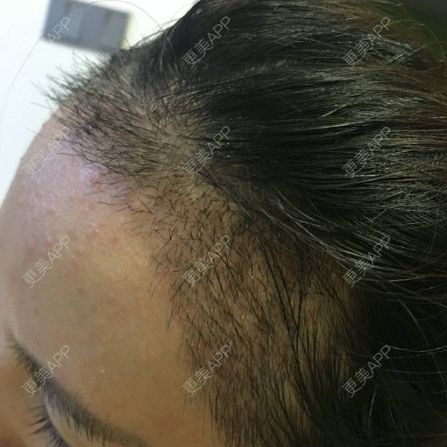 更美 - 琉璃玥的植眉经验 | 美购日记 | 南昌