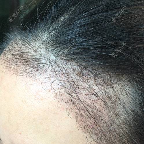 更美 - 琉璃玥的植眉经验 | 美购日记 | 南昌