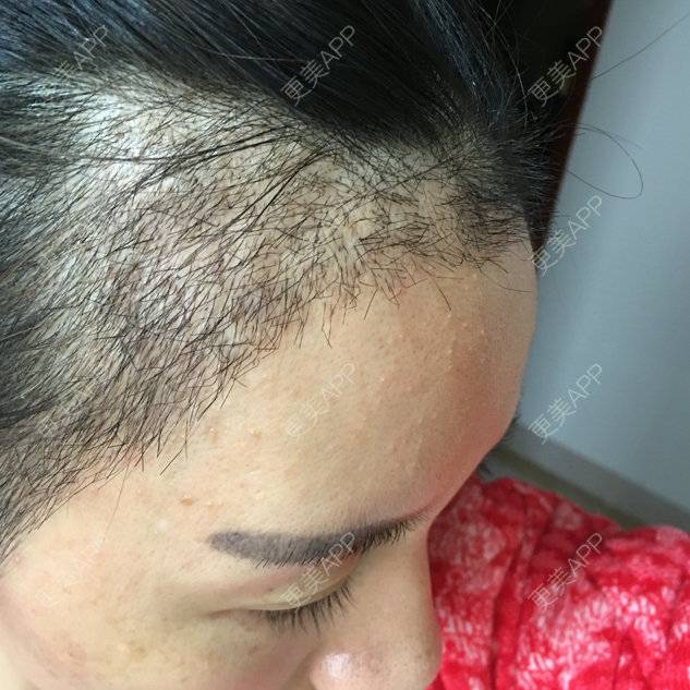 更美 - 琉璃玥的植眉经验 | 美购日记 | 南昌