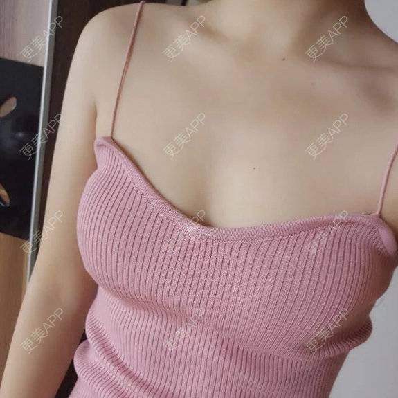 更美 - 逗bee的隆胸手术修复经验 | 广州 | 隆胸手术修复