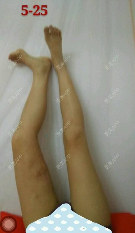 更美 - 4528664的经验 | 美购日记 | 吸脂瘦臀部 | 瘦身美体 | 吸脂瘦大腿1 | 深圳