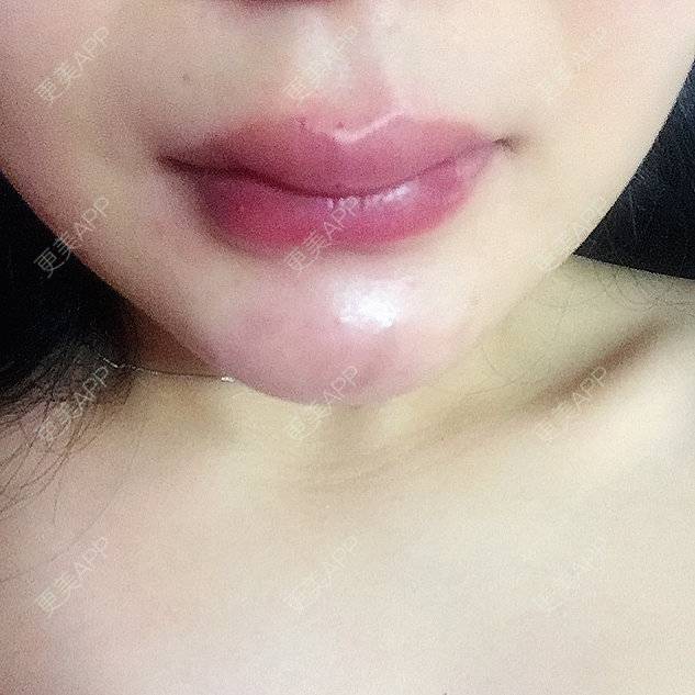 更美 - 芳芳芳芳芳的经验 | 玻尿酸唇部 | 济宁