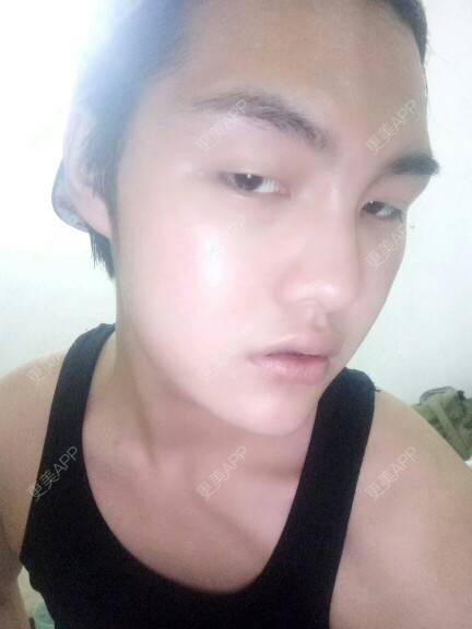 更美 - GD.的经验 | 美购日记 | 自体脂肪丰额头 | 郑州