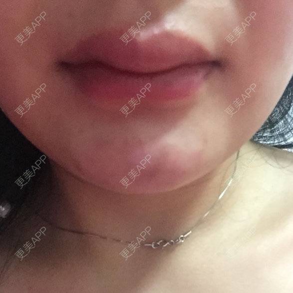 更美 - 芳芳芳芳芳的经验 | 玻尿酸唇部 | 济宁