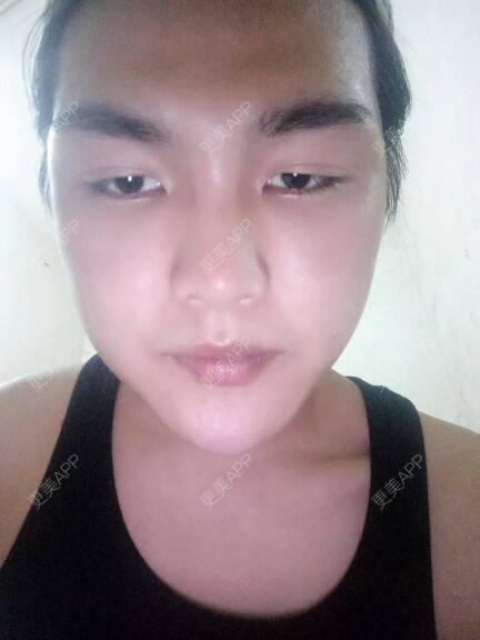 更美 - GD.的经验 | 美购日记 | 自体脂肪丰额头 | 郑州