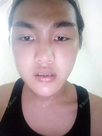 更美 - GD.的经验 | 美购日记 | 自体脂肪丰额头 | 郑州